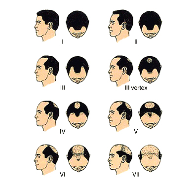 Norwood Scale